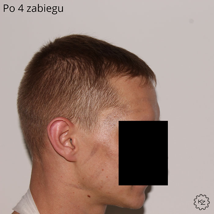 usuwanie tatuażu
